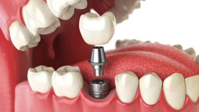 Klinik Gigi Spesialis Prosthodonsi Indramayu